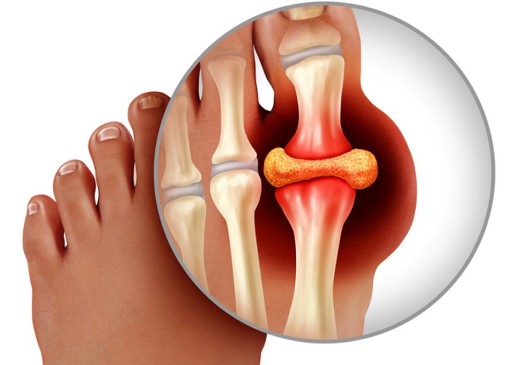 엄지발가락-통증