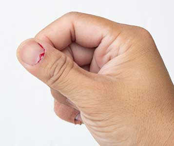 손톱-갈색-세로줄-상처