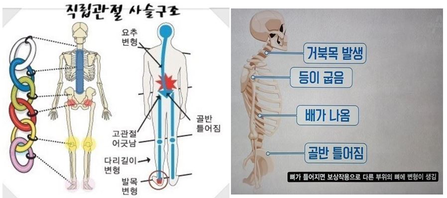 직립신체관절은 사슬 구조로 목, 등, 배, 골반관절은 상호영향을 주어 틀어지게 됩니다.