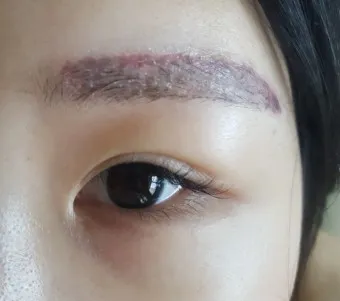 눈썹 문신 제거 방법 꿀팁_37