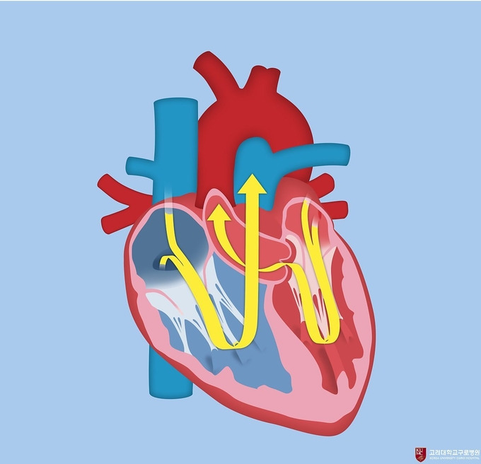 심장판막증 수술 비용