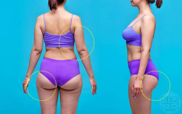 부위별 살찌는 이유 승마살 팔뚝살 뱃살 옆구리살 등살