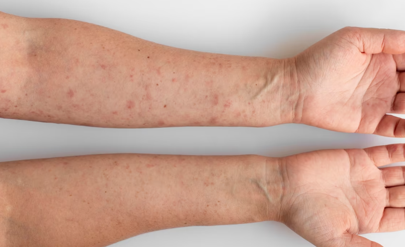 아토피 피부염의 증상