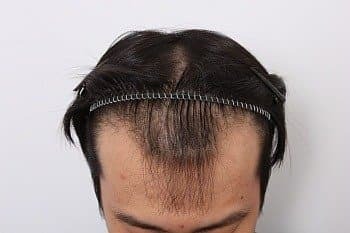 모발이식 후기