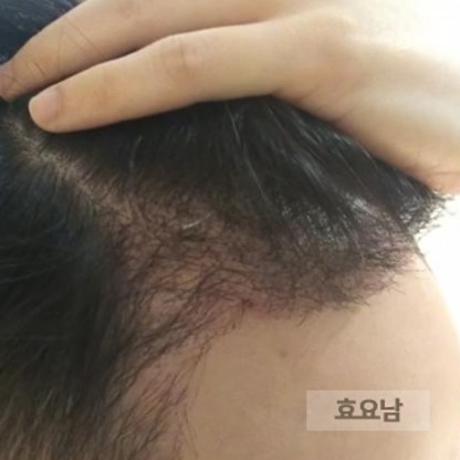 M자 모발이식-2주차-상태-1