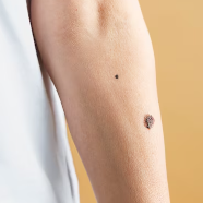 피부암 초기증상 19