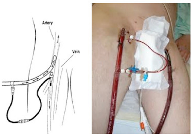 Distal_Perfusion