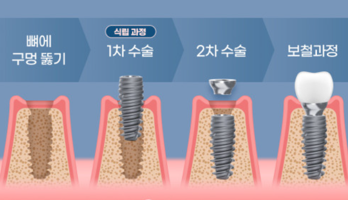 임플란트 가격비교 사이트