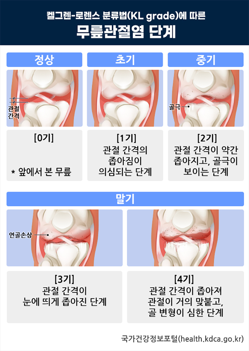 무릎관절염 단계