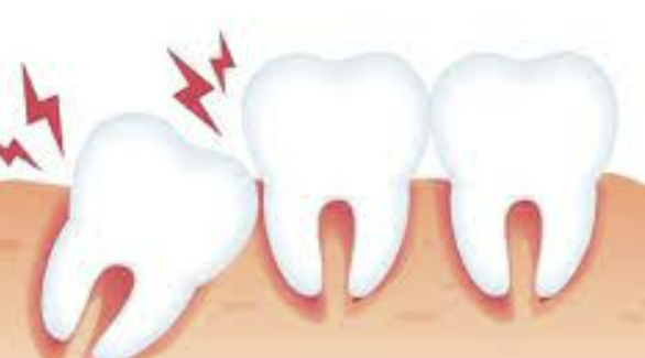 사랑니 발치후 식사 알아보기 커피, 흡연, 음주 정보