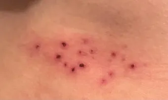 경기도 대상포진 무료접종 연령 기준 정리로 안내_13