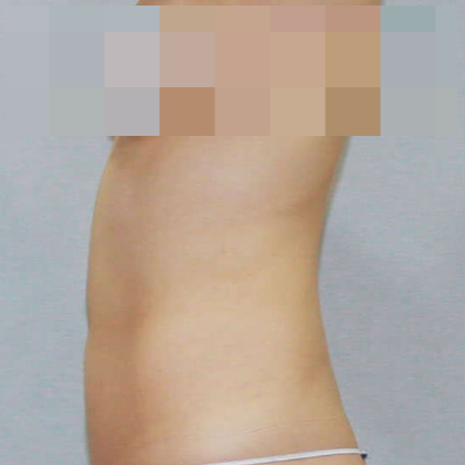 복부미니지방흡입 효과