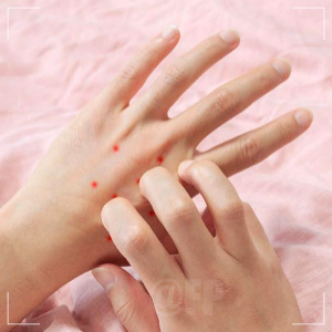 코로나 증상 발진