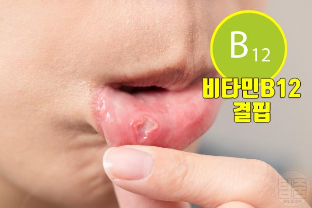 필수 비타민 부족 결핍 증상 구내염