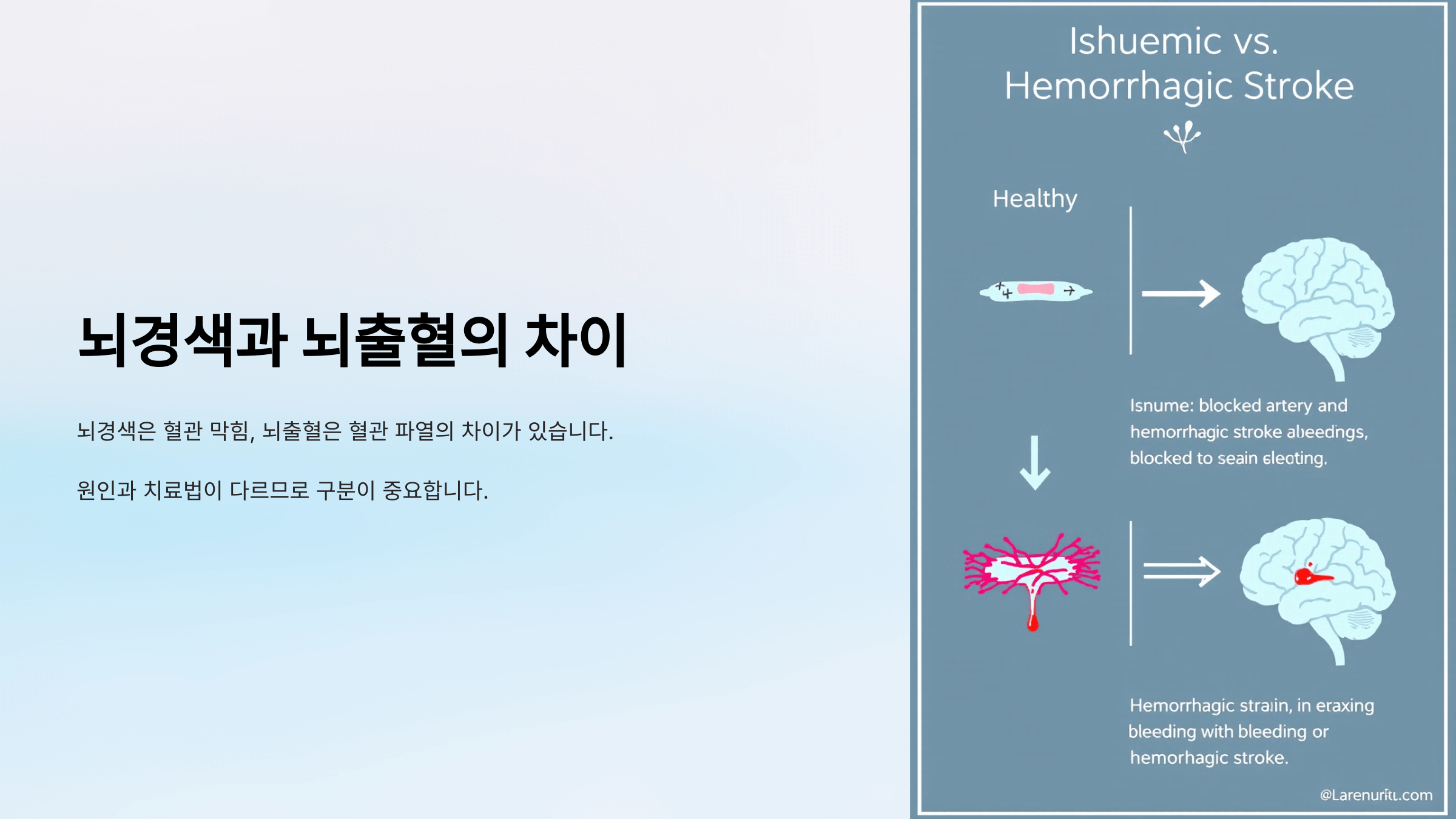 뇌경색과 관련된 사진입니다.