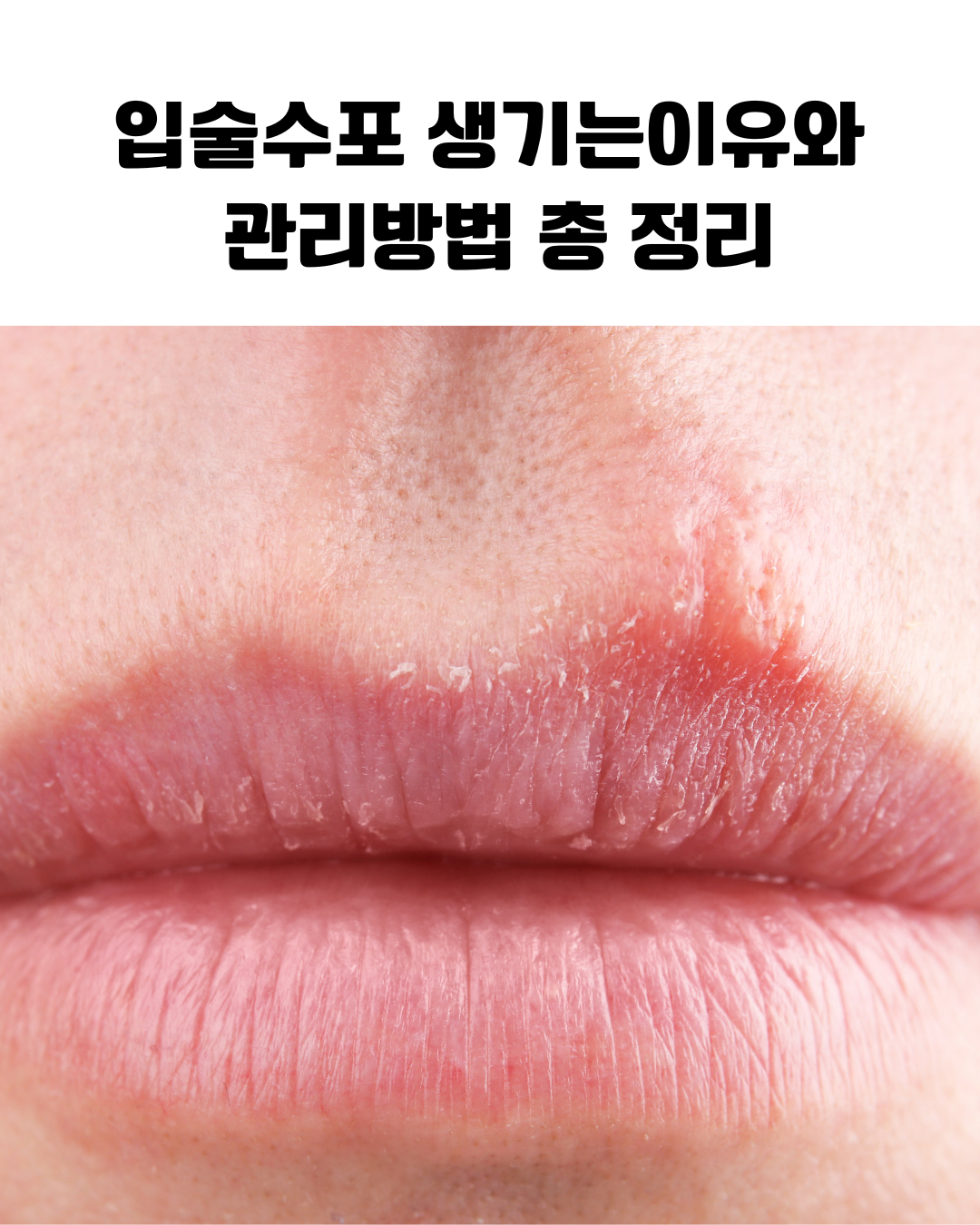 입술 수포 구순포진 발생 원인과 단계별 증상 진행 과정을 나타낸 피부 건강 정보 그래픽으로 헤르페스 바이러스 재활성화 메커니즘 설명 이미지