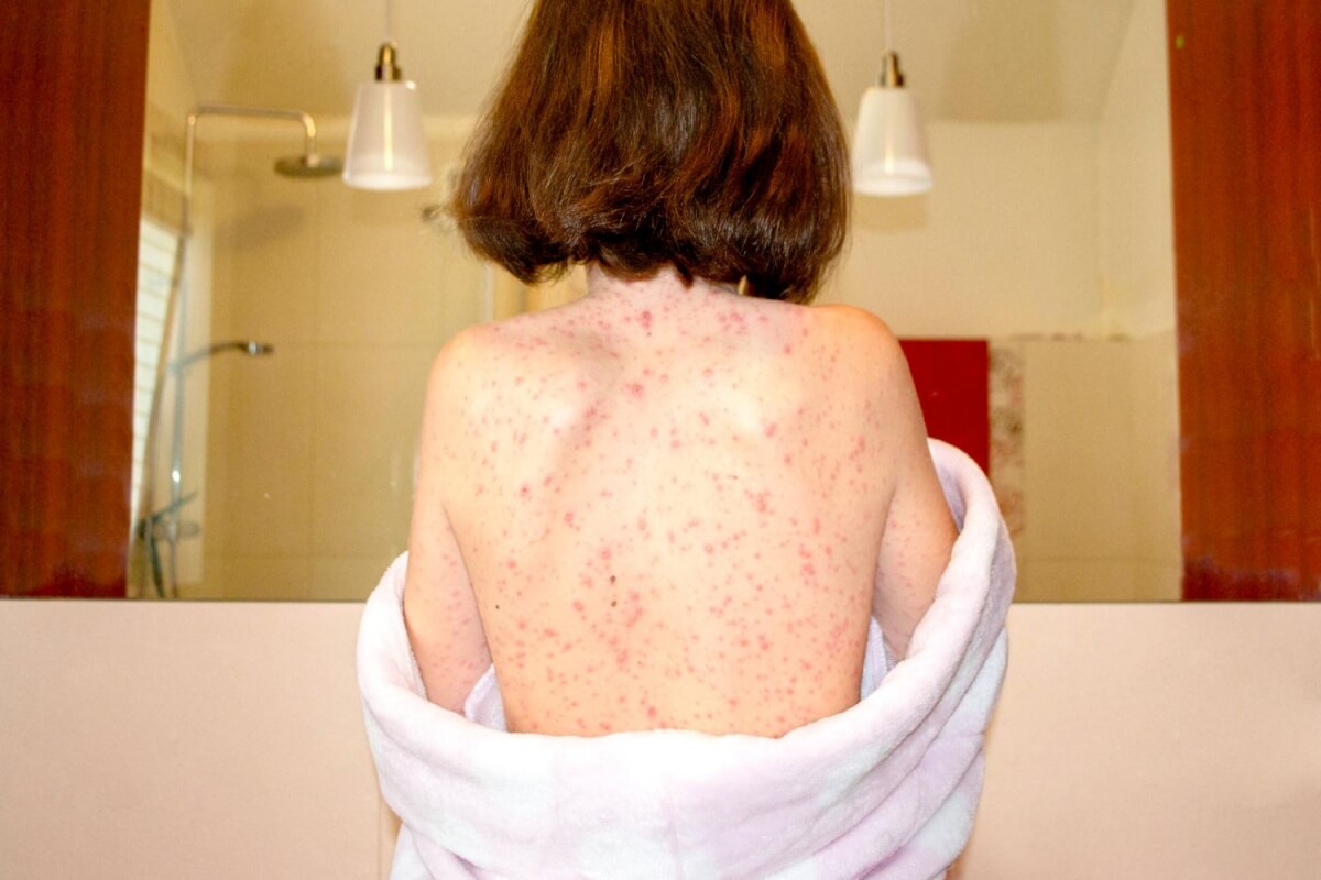 홍역으로-인해-생긴-발진