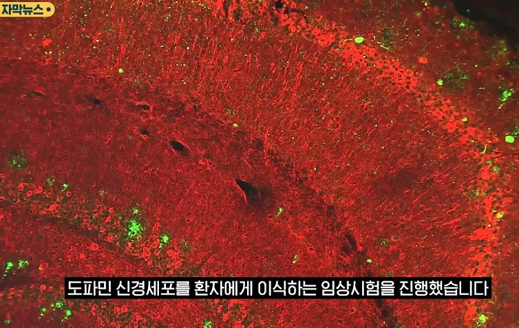 파킨슨-신경외과-장진우-교수