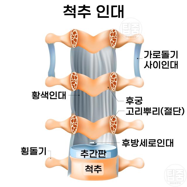 허리가 찌릿 아플때 척추관협착증 증상 원인 척추인대