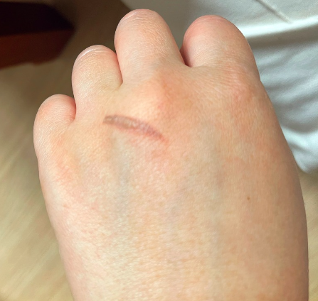 표재성 2도 화상