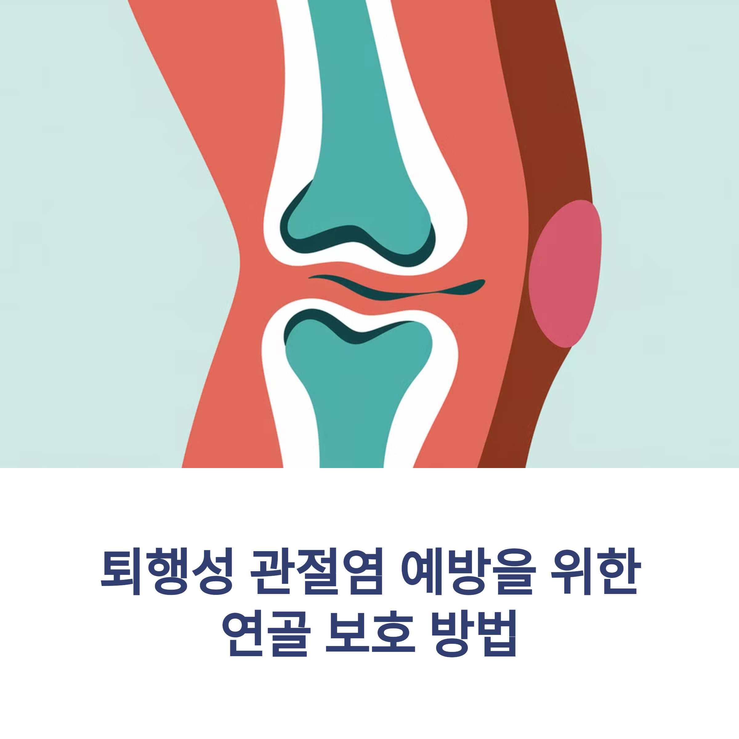 퇴행성 관절염 예방을 위한 연골 보호 방법