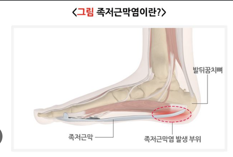 족저근막염(1)
