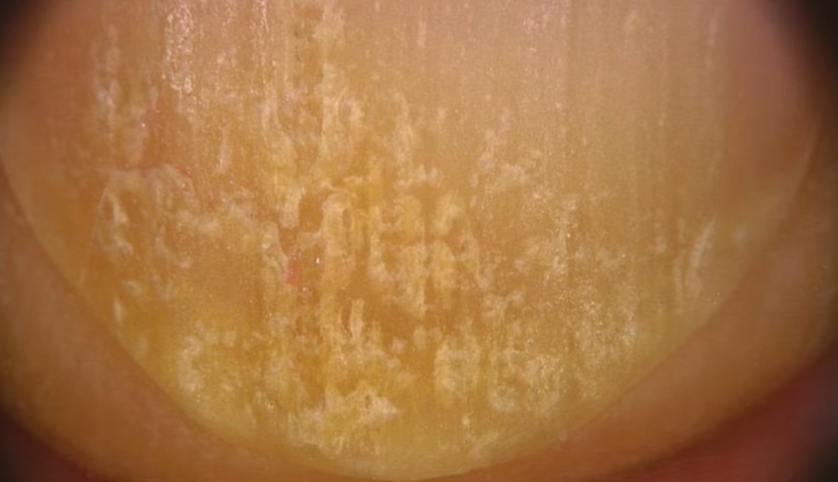 손톱이 잘 부러지는 이유