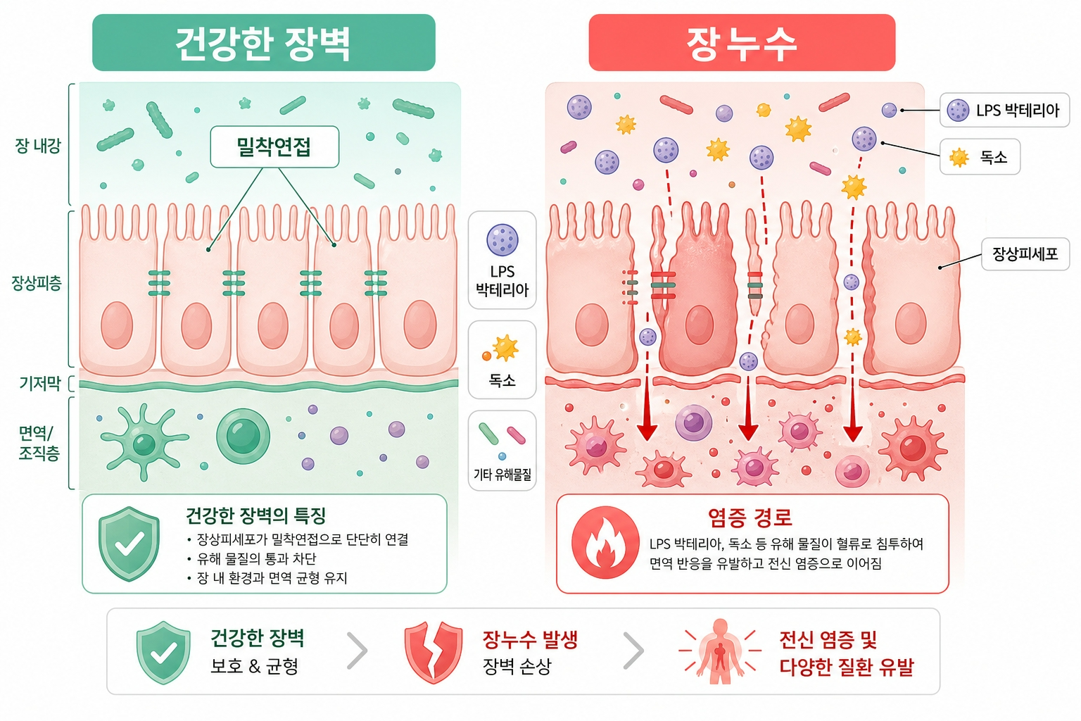 장누수증후군 원리 LPS 염증 인포그래픽