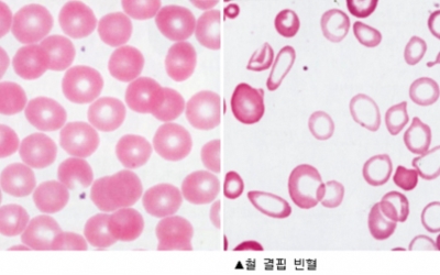 빈혈 이미지