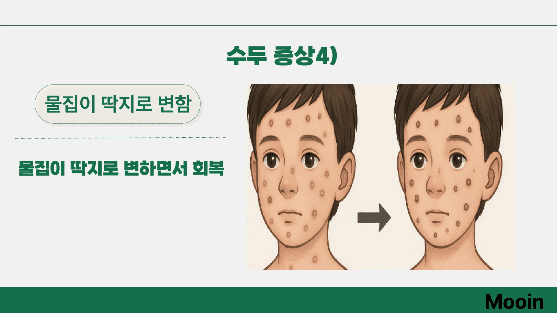 수두 증상4)