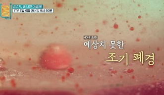 조기폐경
