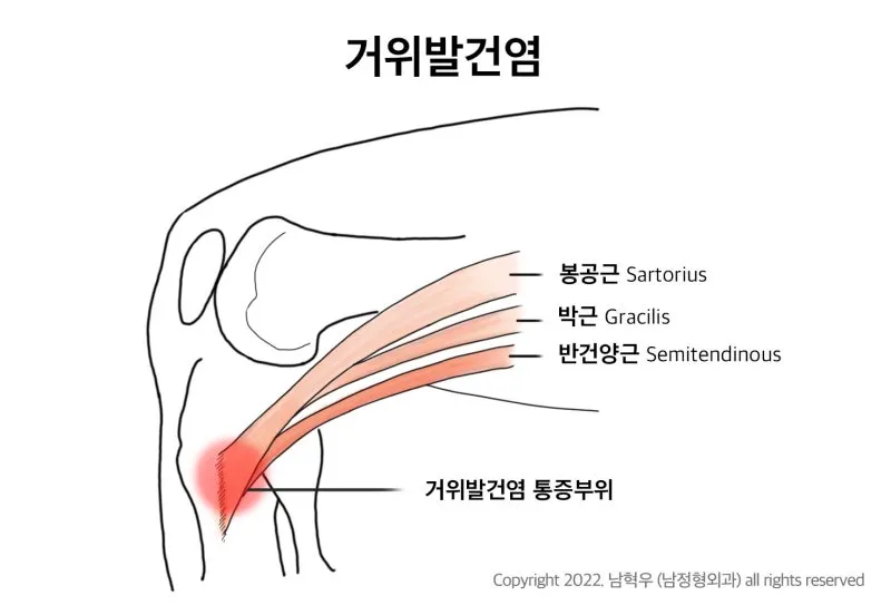 거위발 건염 원인과 증상 무릎 안쪽 통증 치료법 정리_8