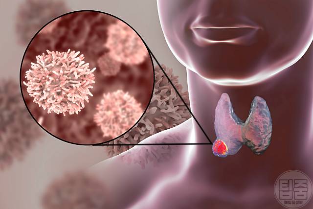 갑상선암 증상 갑상선암초기증상