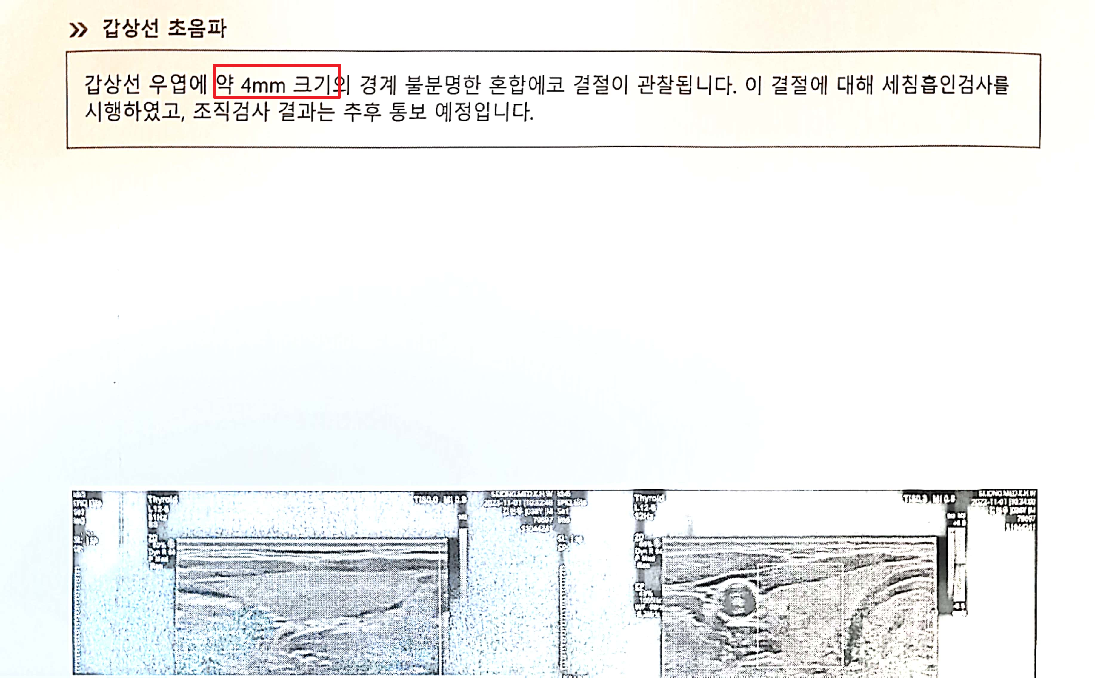 갑상선 결절 크기 소견