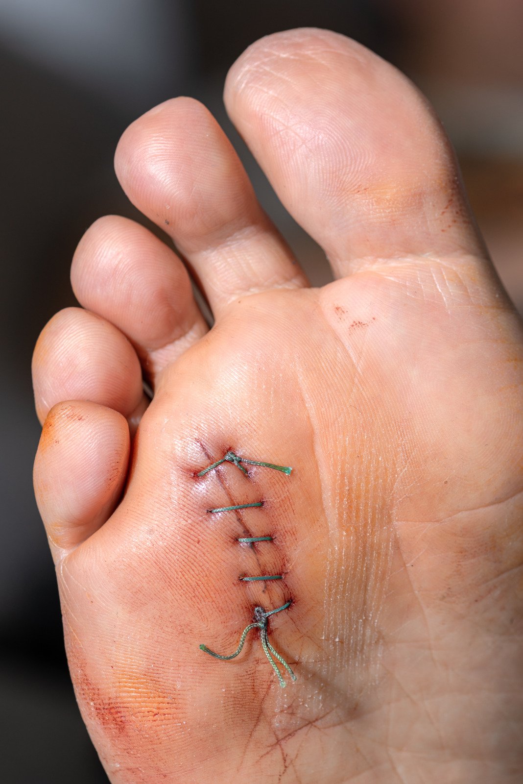 모튼 신경종 (Morton's Neuroma) - 증상, 원인 및 효과적인 치료 방법