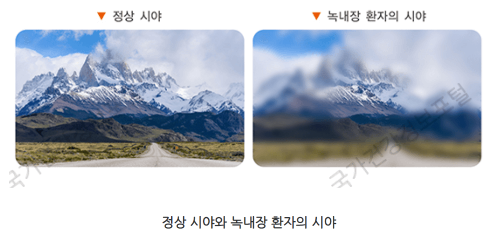 녹내장