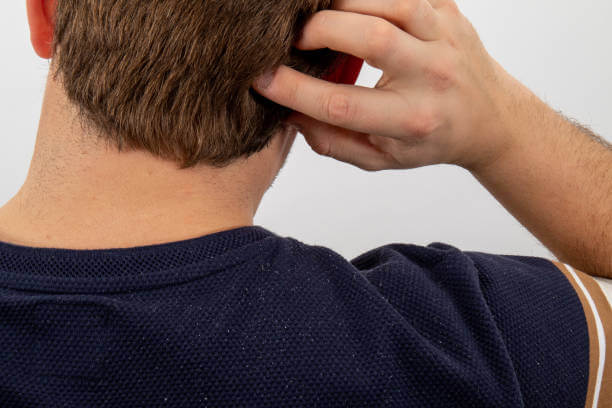 샴푸만 바꿔도 달라진다? 지루성 두피염 원인과 생활 습관 관리법