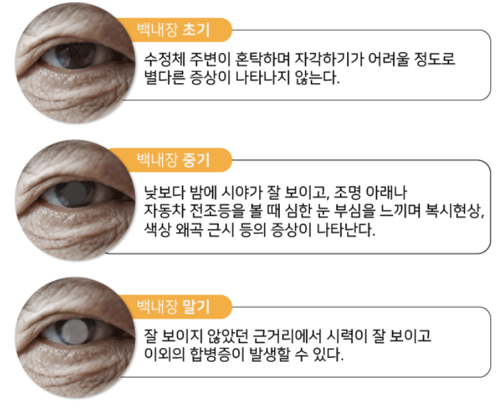 백내장 증상 1