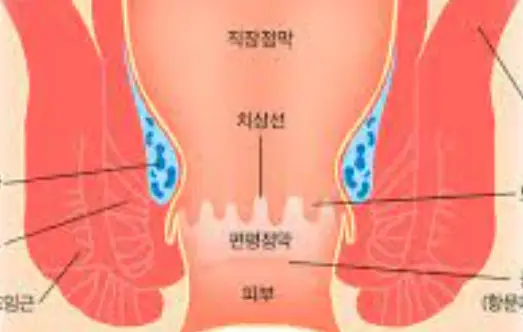 치질-증상-자가치료법-건강