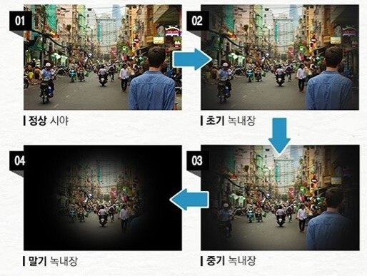 녹내장
