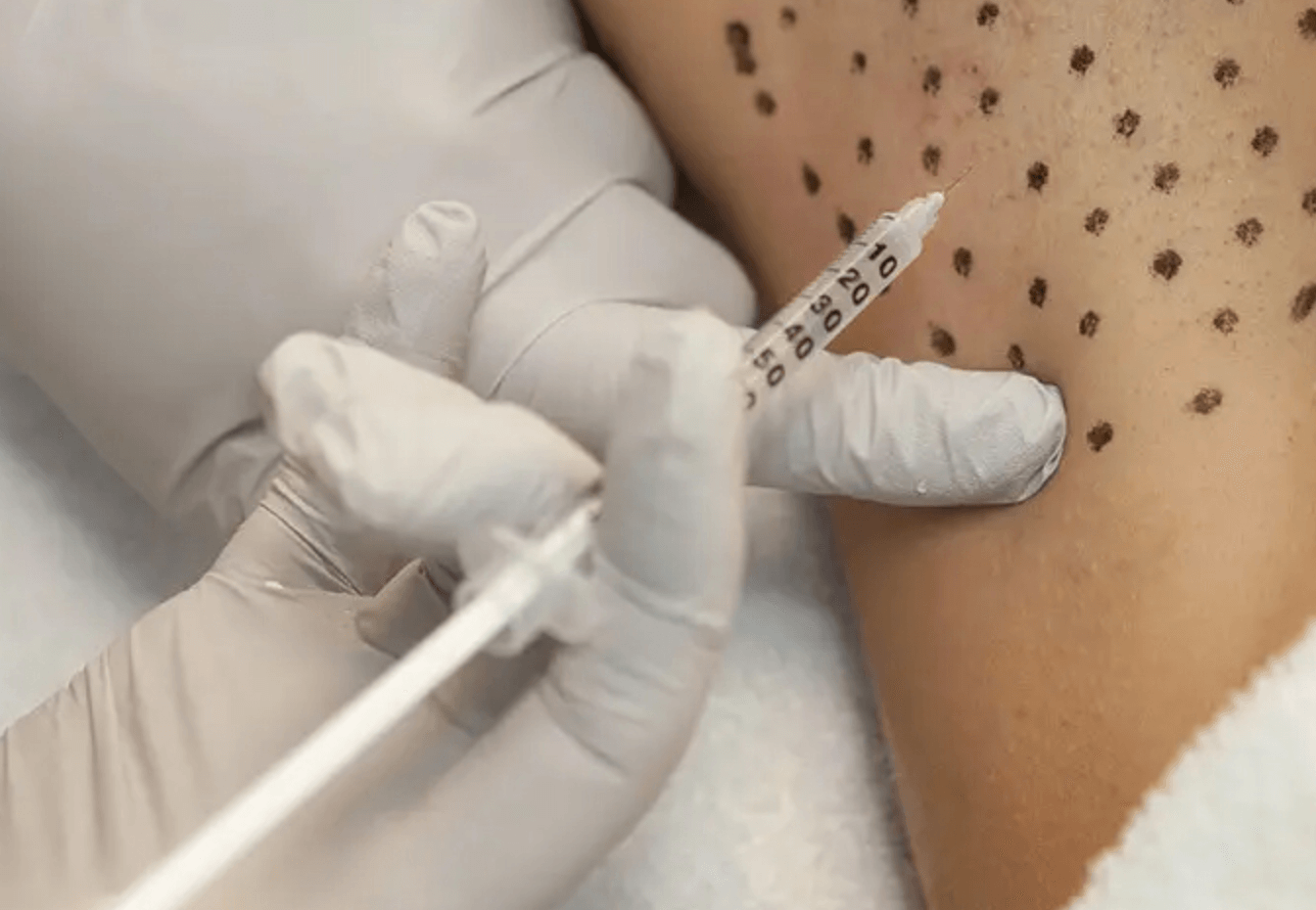 겨드랑이 다한증 치료