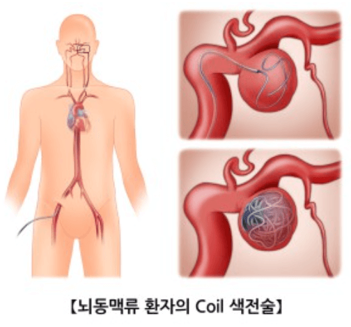 뇌동맥류코일색전술