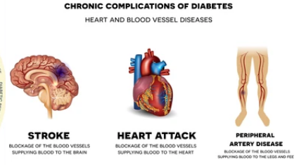 당뇨합병증 심혈관