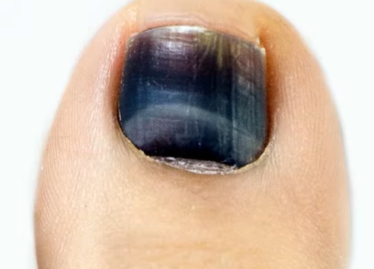 발톱이 검게 변하는 이유