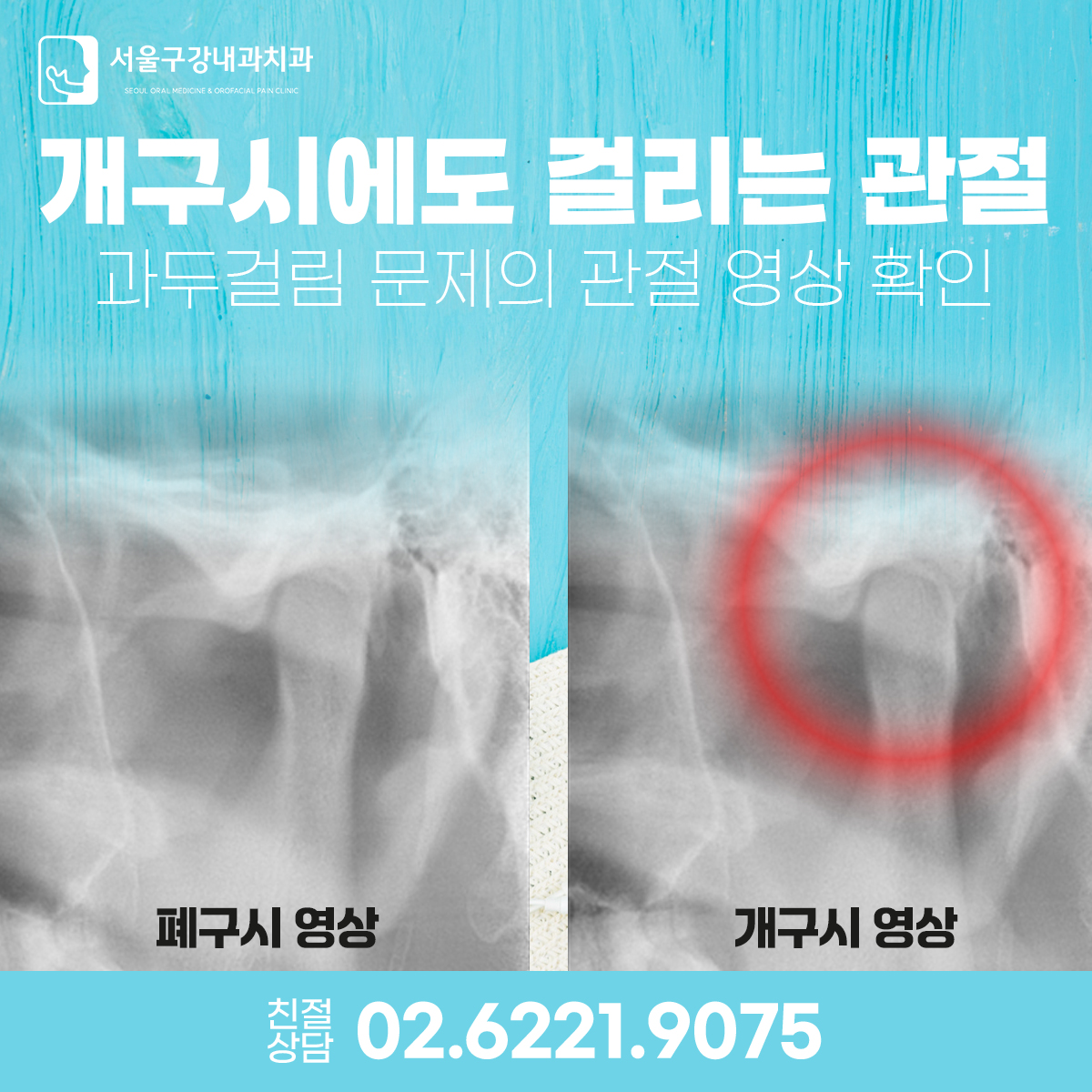 턱관절 치료 후 입이 약 39mm까지 벌어지는 모습, 개구제한 개선 사례와 턱관절 치료 결과 이미지