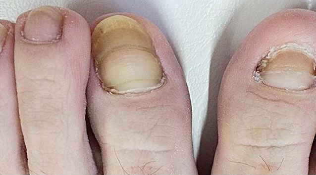 발톱 무좀 상태