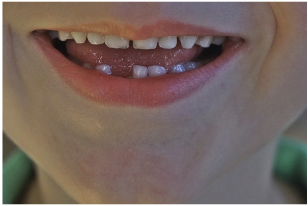 아이의 이빨 빠진 모습