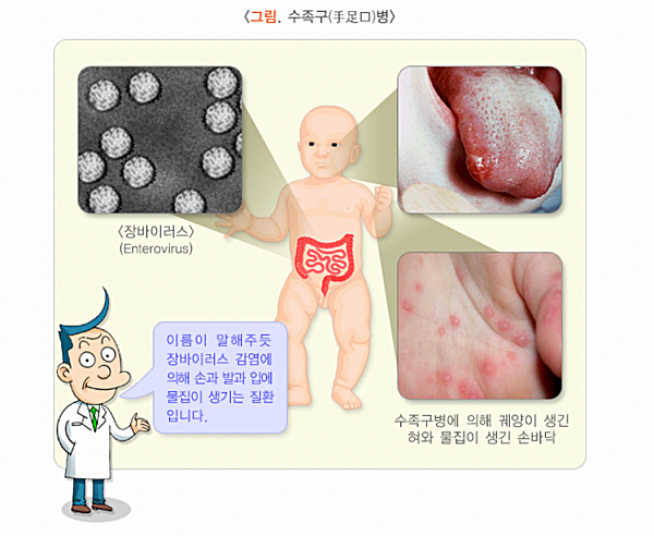 수족구란?_출처:질병관리청