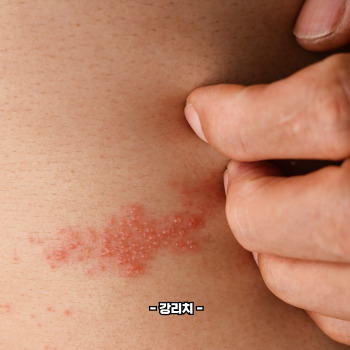 대상포진 치료방법