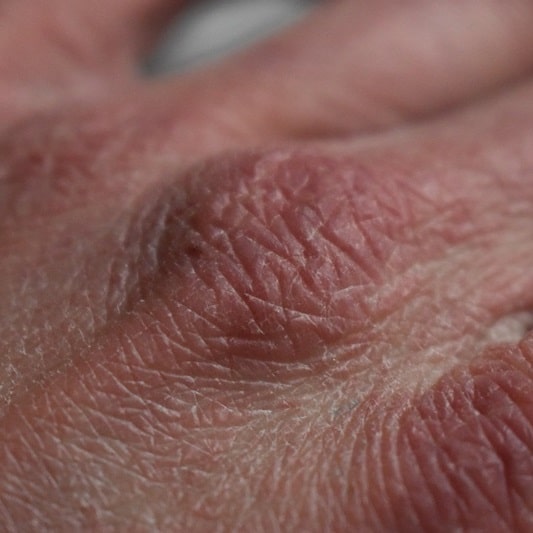 갑상선 기능 저하증 증상